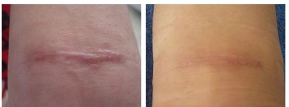 廣州治疤痕醫(yī)院專家推薦，哪家治疤痕效果好？