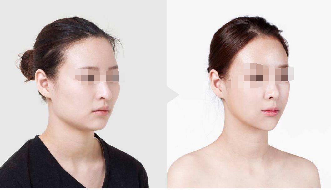 膠原蛋白面部填充持續(xù)效果及價(jià)格解析