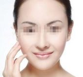 去除眼角魚尾紋，4個簡易方案分享