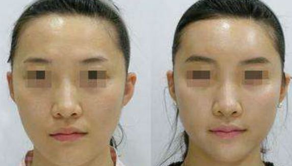 腹部脂肪去除的優(yōu)點(diǎn)是什么？