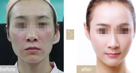 眼瞼內(nèi)翻手術(shù)的優(yōu)勢與效果