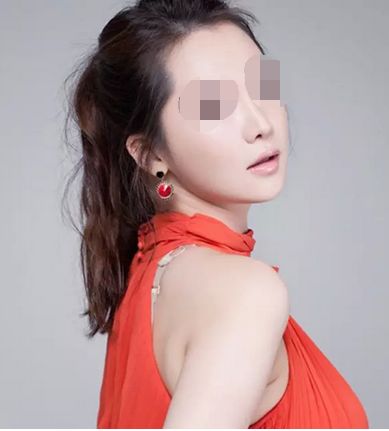 雙眼皮整形術(shù)術(shù)后需要注意些什么？