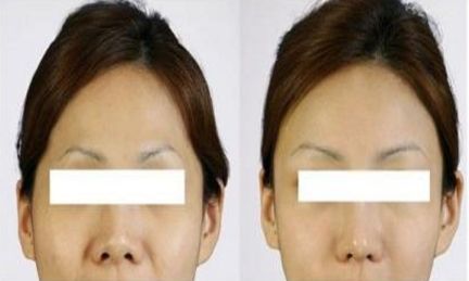 男生開始關(guān)注臀部美容，吸脂豐臀自體脂肪成熱潮！你還在猶豫？