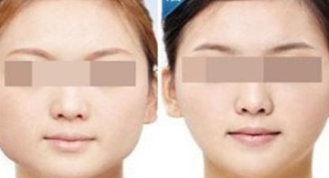 體脂填充修復(fù)乳房失敗后的方法與費用