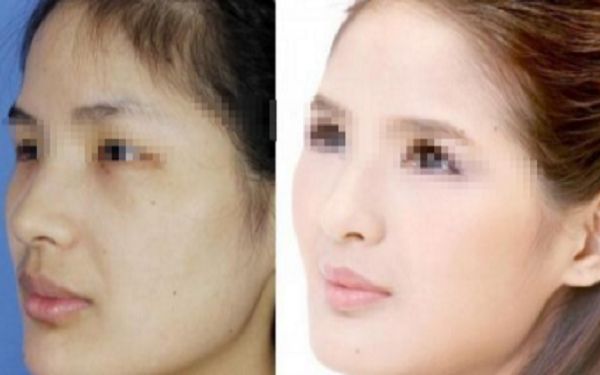 內(nèi)眼角手術(shù)失敗的原因解析，你需要了解的事項(xiàng)