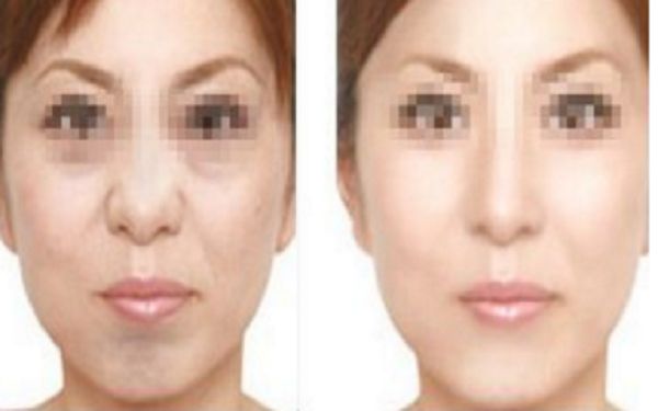 眼袋手術(shù)后疤痕何時(shí)消失？手術(shù)后禁食期應(yīng)該如何安排？