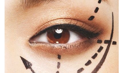 雙眼皮手術(shù)恢復(fù)時間分析及注意事項