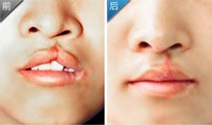 成都整形醫(yī)院隆鼻手術(shù)價格及影響因素全解析