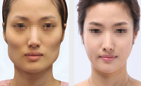 如何令白天使注射法令紋展現(xiàn)最佳效果？領(lǐng)先的注射美容技巧再揭秘