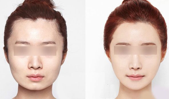 神奇！術(shù)后皮膚煥然一新，讓你驚喜不已的修復(fù)效果