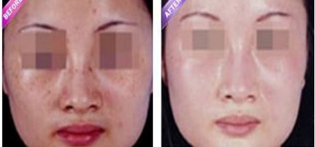 激光縮陰是否會導(dǎo)致副作用？找到安全有效的解決方法