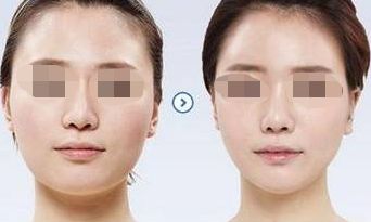 腹部吸脂：瘦腰有效的護理技巧與優(yōu)點