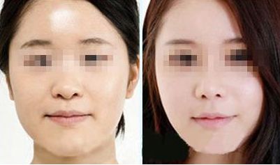 激光去除眼袋，持久效果有多久？價格如何，眼周抗衰秘笈大揭示