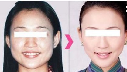 注射隆鼻會(huì)對(duì)身體健康產(chǎn)生什么影響