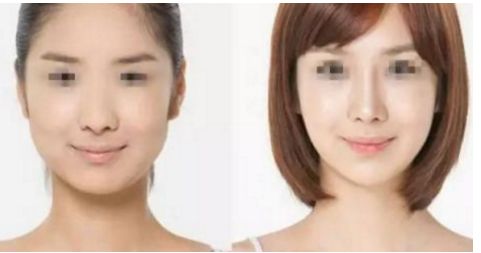 威寧隆胸手術效果如何？術后持久無需擔心！