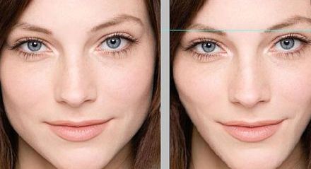 透明質(zhì)酸隆鼻：步驟詳解，效果驚艷！