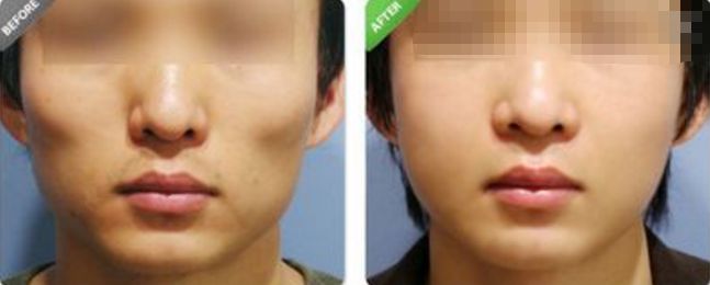 隆鼻手術(shù)價格及手術(shù)前注意事項解析