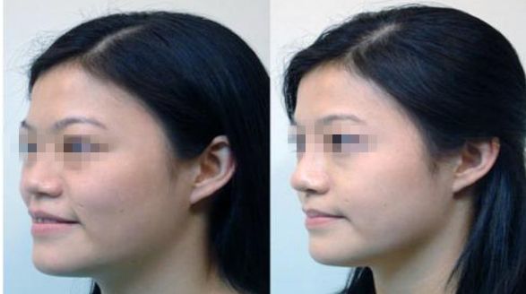 面部輪廓整形：手術(shù)解析及常見技術(shù)解讀