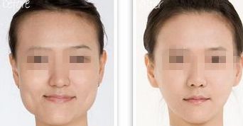 眼袋手術(shù)后能否運(yùn)動？術(shù)后需要多久平躺？