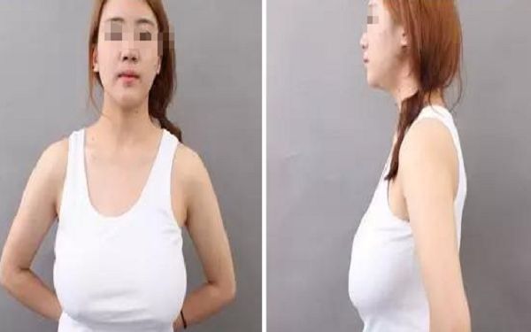 如何避免失敗的隆鼻整形？