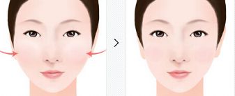 年輕人瘦臉手術不同等級全面對比