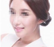 豐富面部輪廓，改善面部凹陷的有效方法！