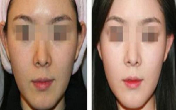 假體隆鼻價(jià)格、效果及相關(guān)信息