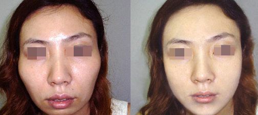 南京硅膠鼻隆和膨體鼻隆哪個(gè)更適合