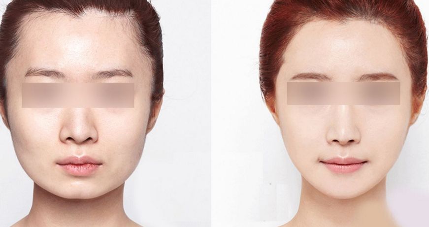 注射隆鼻：維持效果多久？