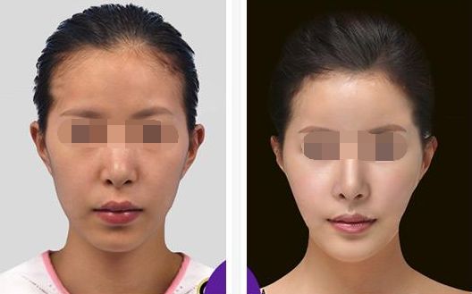 臂部脂肪減少的要點(diǎn)，匯總臂部吸脂注意事項(xiàng)