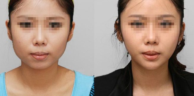 低凹鼻梁怎樣通過隆鼻手術(shù)改善？