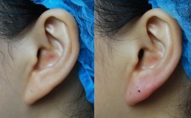 透明質(zhì)酸隆鼻與手術(shù)隆鼻的區(qū)別，自體軟骨隆鼻效果如何？