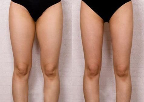 修復(fù)雙眼皮不自然的方法及技巧分享