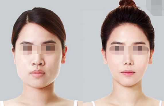 雙眼皮消腫速度？這個(gè)方法幫你快速恢復(fù)！