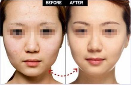 開外眼角手術(shù)：提升臥蠶、增大眼睛，效果有多好？