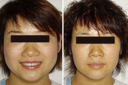 隆鼻手術(shù)后的常見(jiàn)問(wèn)題有哪些