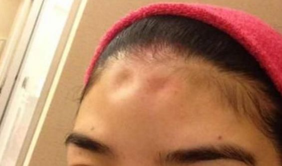 面部輪廓固定多長時間，價格和抗衰原理揭秘！