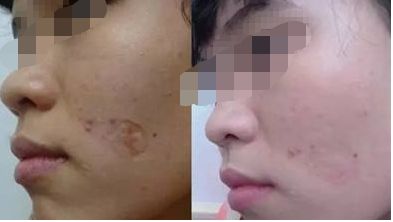 彩光嫩膚維持時間影響因素總結(jié)