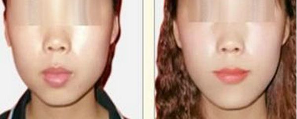 透明質(zhì)酸隆鼻的優(yōu)勢(shì)及適合人群解析