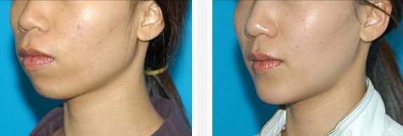 皮膚激光療程的價(jià)格和效果一覽，讓你輕松了解！