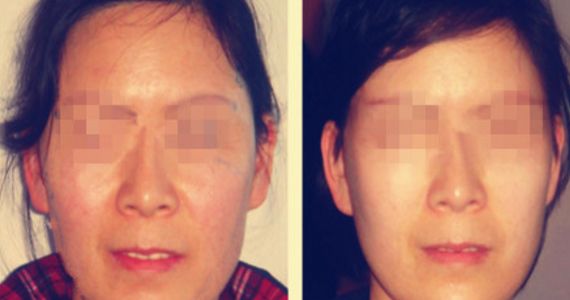 opt光子嫩膚費(fèi)用及價(jià)格查詢?cè)斀?，了解opt光子嫩膚真實(shí)價(jià)格與口碑評(píng)價(jià)