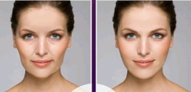 痤瘡如何使用激光緩解？了解一下痤瘡護(hù)理方法吧！