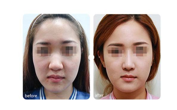 7d聚拉提果真的那么神奇嗎？挽救肌膚年齡，還讓你重獲青春之美！