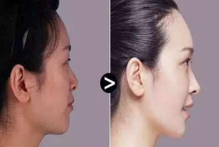 雙眼皮手術效果如何？割出雙眼皮有什么關鍵？