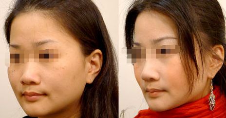 廣州海峽雙眼皮好評(píng)如潮，有效突顯雙眼魅力