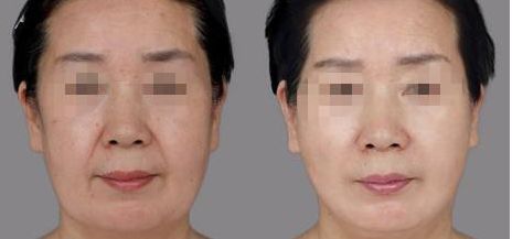 磨骨風(fēng)險(xiǎn)大？解讀術(shù)后出血、感染、神經(jīng)麻木等風(fēng)險(xiǎn)與費(fèi)用