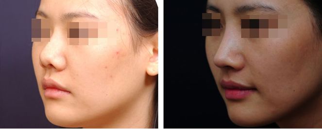 尹林麗格咬肌肥大如何改善，放大問題果真靠譜嗎？