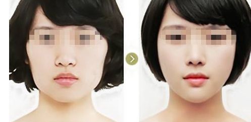 面部提升技術哪家強？拉皮、脂肪填充、歐洲之星各有優(yōu)勢