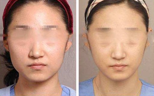 臀部吸脂手術(shù)：詳解夢寐以求的豐臀過程