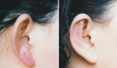 打造挺拔鼻梁，揭秘5種鼻綜合隆鼻技術(shù)！注意事項(xiàng)不可忽視